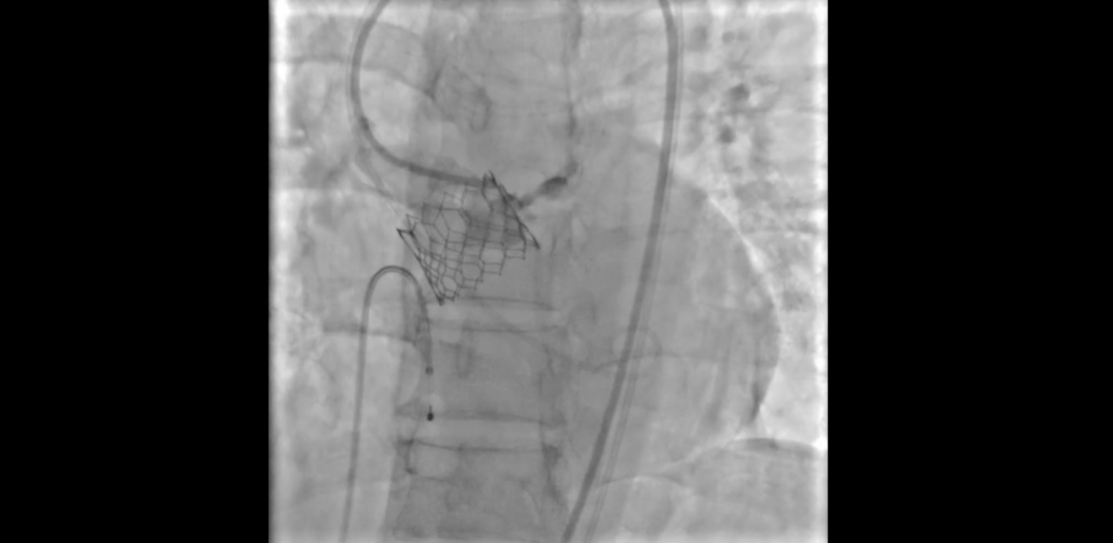 Percutaneous Approach With Coil Embolization for Annular Rupture During